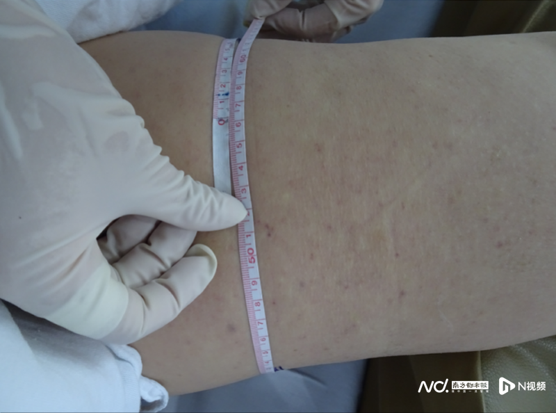 imagefile 副本女子癌症术后腿肿如“象腿”,显微手术巧消肿294.png
