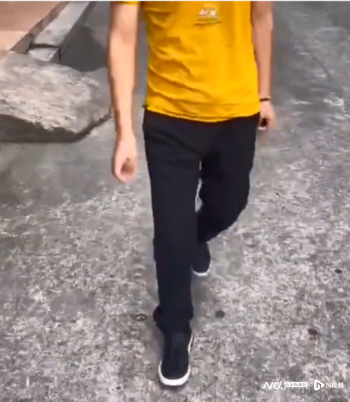 imagefile 副本小伙马蹄足内翻跛行二十载,手术矫形恢复正常行走1050.png
